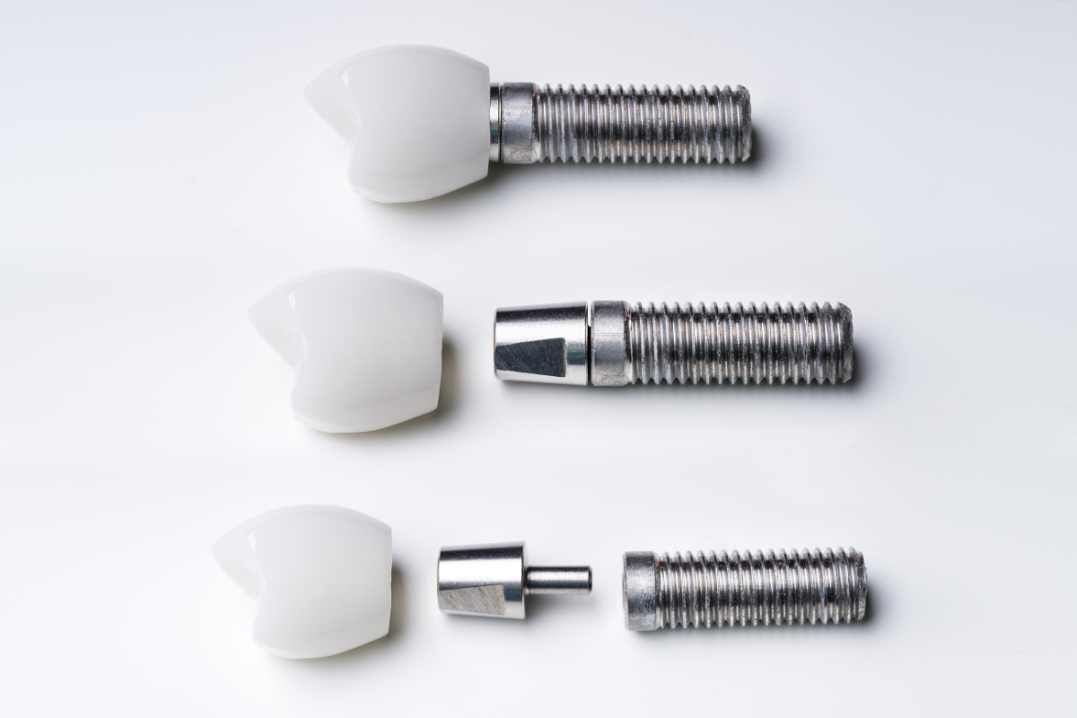 Implant zęba – co warto wiedzieć przed wstawieniem? 